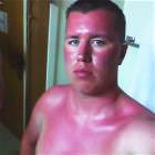 Sunburn